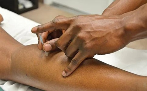 針灸治療偏頭痛的體會!